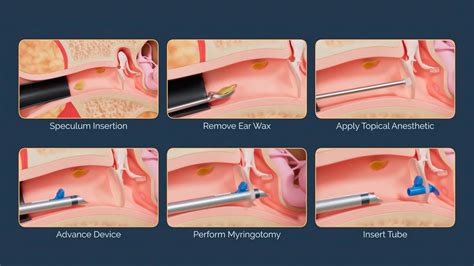 Ear Tube Insertion Procedure
