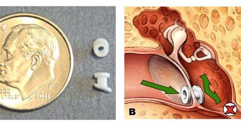 Ear Tubes