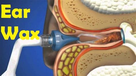 Ear Wax Removal