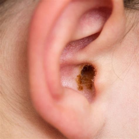 Earwax Buildup