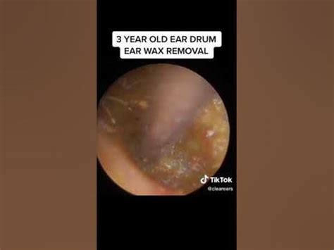 Earwax Impaction