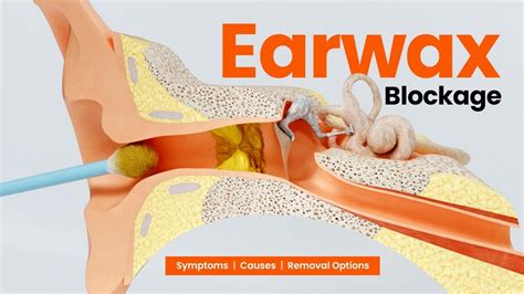 Earwax Impaction Prevention