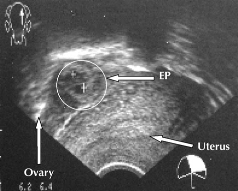 Ectopic Gestation Conclusion