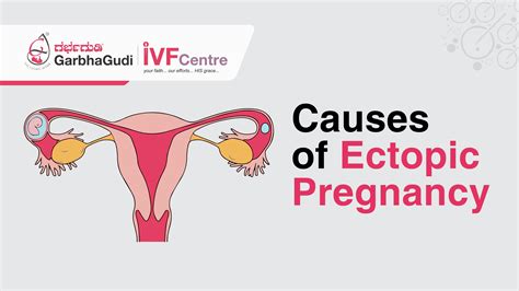 Ectopic Pregnancy Causes