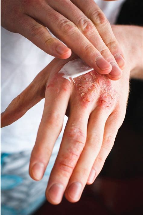 Eczema Management