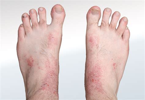 Eczema On Toes