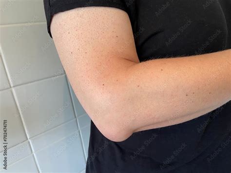 Elbow Bursitis