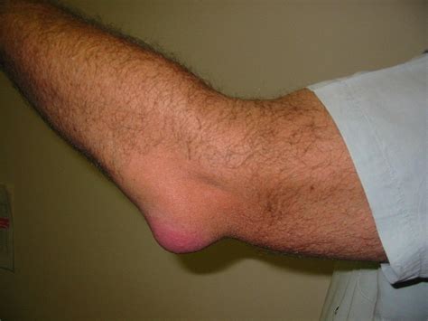 Elbow Bursitis Recovery