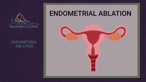 Future of Endometrial Ablation