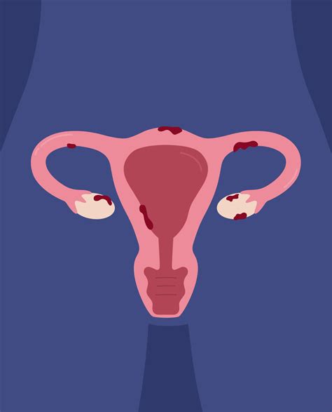Endometriosis