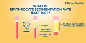 Erythrocyte Sedimentation Rate Test