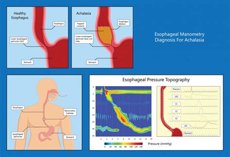 Esophageal Manometry