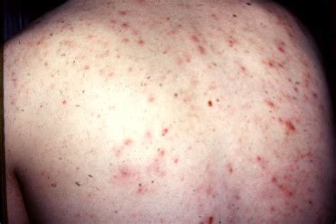Excoriation Disorder