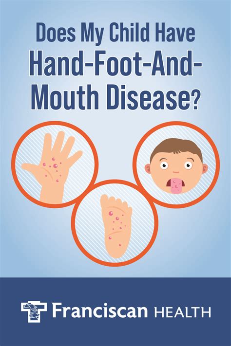 FAQs about Hand Foot Mouth Blister