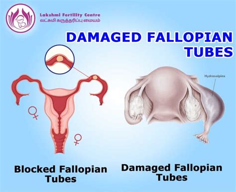Fallopian Tube Damage