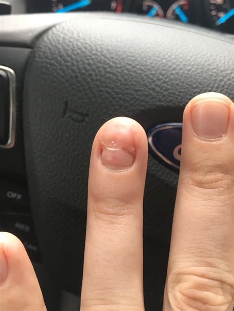 Final Thoughts on Fingernail Loss