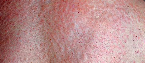 Fix Yeast Rash