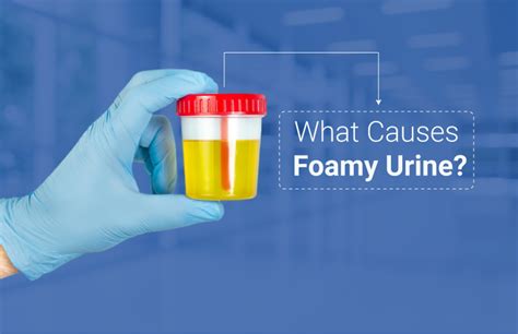 Foamy Urine Diagnosis