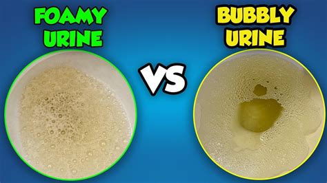 Foamy Urine Types