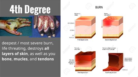Fourth Degree Burns
