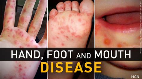 Future Directions for Hand Foot Mouth Disease Research