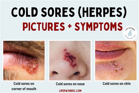 Future Directions for Herpes Cold Sore Virus Symptoms