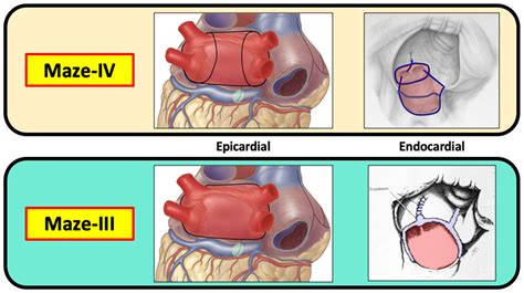 Future Directions in Atrial Fibrillation Surgery