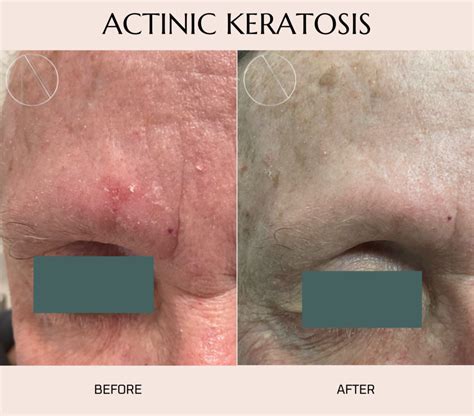 Future Directions in Keratosis Treatment