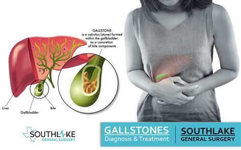 Gallstones Management