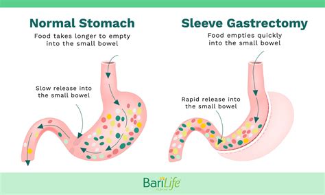 Gastric Dumping Syndrome