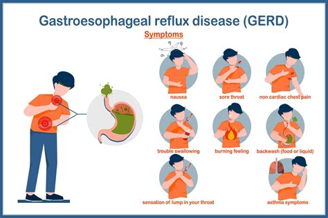 Gastroesophageal Reflux Disease
