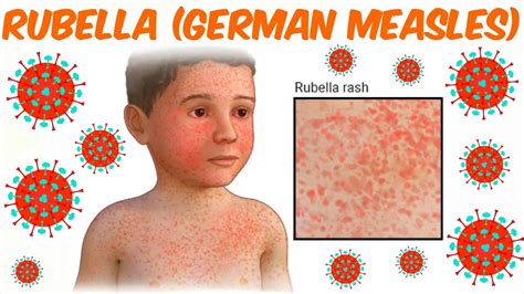 German Measles Outbreaks
