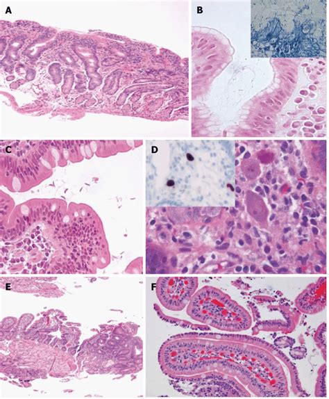 Gluten Enteropathy Blood Test Diagnosis