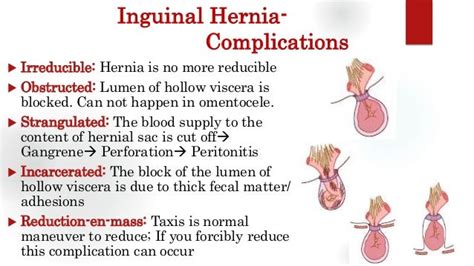 Groin Hernia Complications