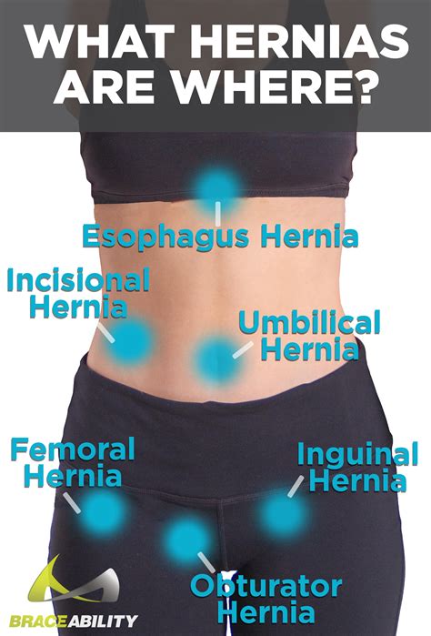 Groin Hernia In Women