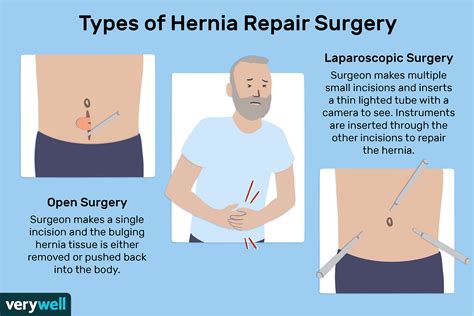 Groin Hernia Repair