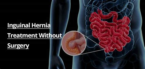 Groin Hernia Treatment