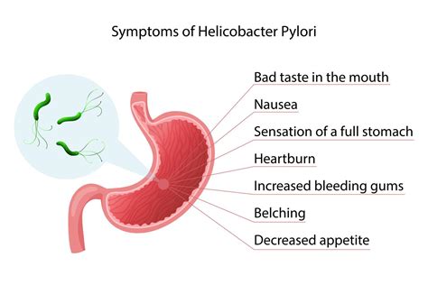 H Pylori Infection Overview