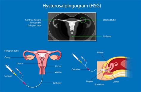 HSG Procedure