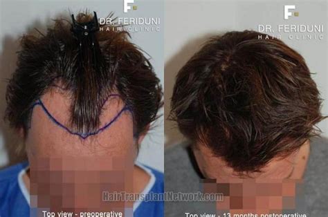 Hair Replacement Surgery Techniques