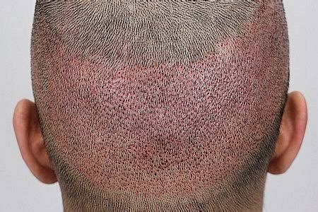 Hair Transplantation