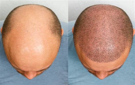 Hair Transplantation Procedure