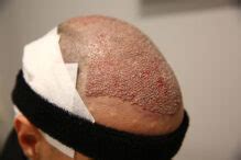 Hair Transplantation Misconceptions
