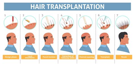 Hair Transplantation Steps