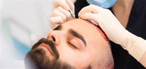 Hair Transplantation Techniques