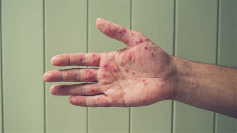 Hand Foot And Mouth Disease In Adults