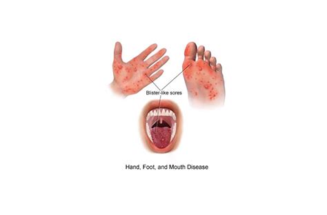 Hand Foot Mouth Disease in Adults