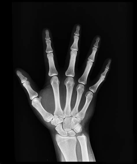 Hand X-Ray Procedure