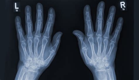 Hand X-Ray Benefits