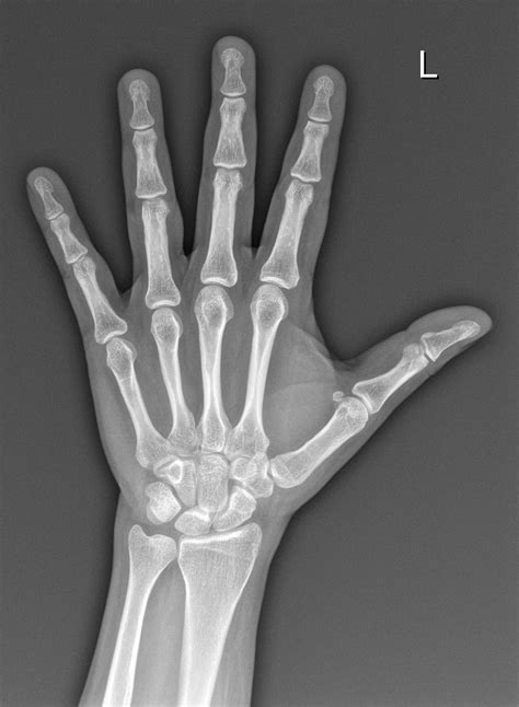 Hand X-Ray Technology